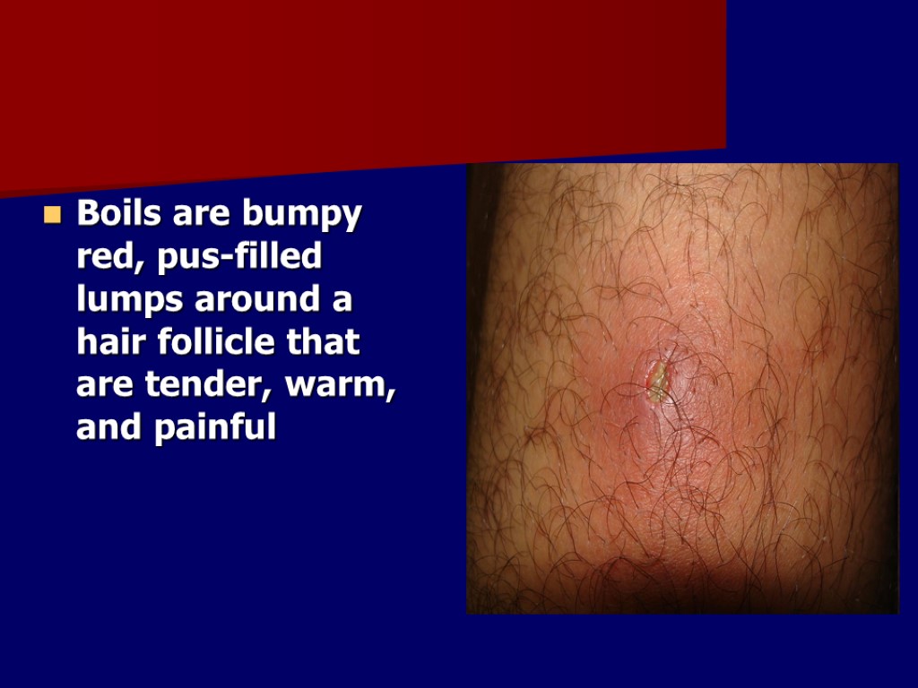 Boils are bumpy red, pus-filled lumps around a hair follicle that are tender, warm,